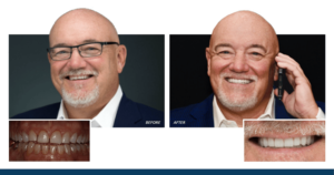 Dr. Farmer's before and after photos from his smile makeover with veneers