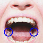 Woman with mouth open wide and wisdom teeth circled