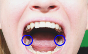 Woman with mouth open wide and wisdom teeth circled